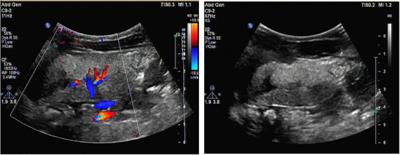 Case report: Early-onset renal failure as presenting sign of Lesch-Nyhan disease in infancy